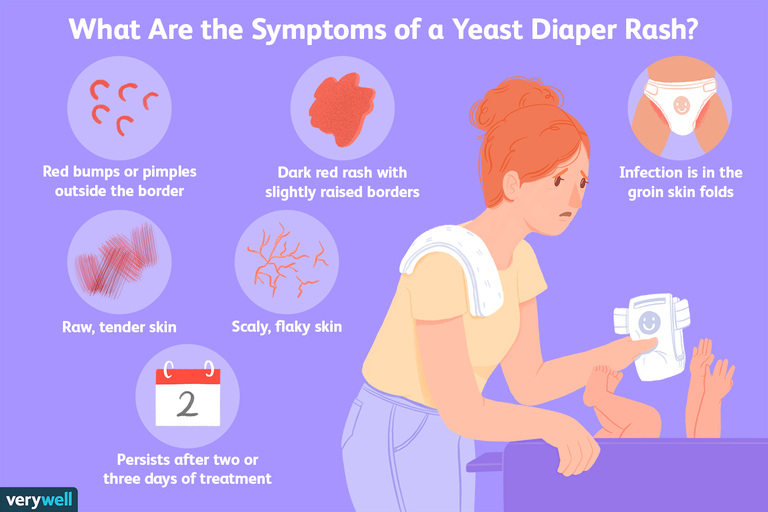 How to Keep your Baby safe from Diaper rash?